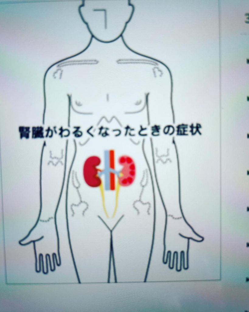 腎臓が悪くなった時の症状身体の異変で浮腫、尿量、夜間尿、頻尿、だるさ、貧血、かゆみ、心血管合併症、骨ミネラル代謝異常がみられる場合は腎臓に異常がある事が多いそうです。