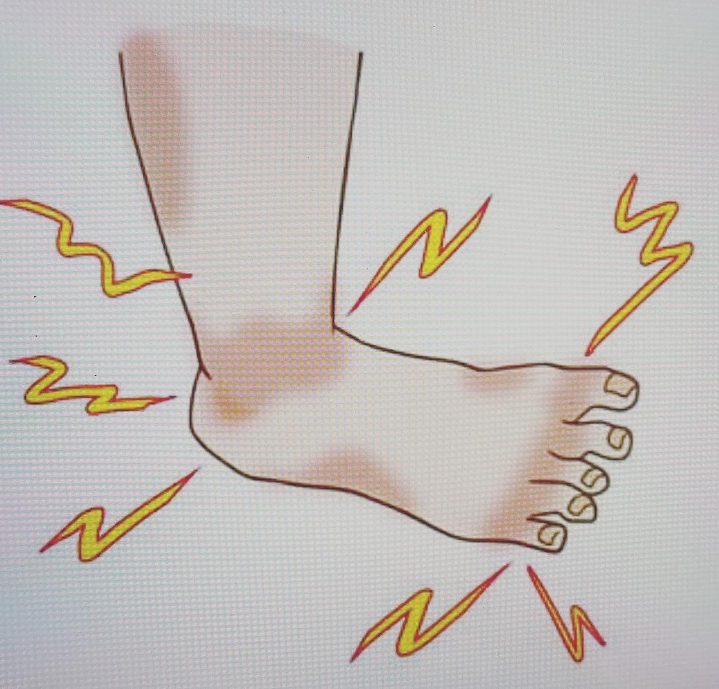 #足の裏、かかとが痛い原因#足底腱膜炎足底筋膜は足底にある膜で、足のアーチを保つ重要な組織です。立って足に体重がかかると、足底筋膜に負荷がかかります。長時間の立ち仕事、体重増加、スポーツによる過大な負荷などで痛むようになると考えられます。