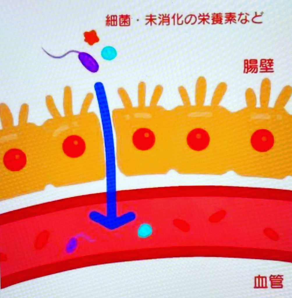 #リーキーガット症候群！腸に穴があいてしまうことで、本来体内には取り込まないはずの細菌や毒素などの有害物質まで体内に取り込んでしまい、さまざまな病状を引き起こす。